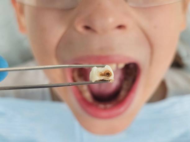 Best Knocked-Out Tooth (Avulsed Tooth) Treatment in South Venice, FL